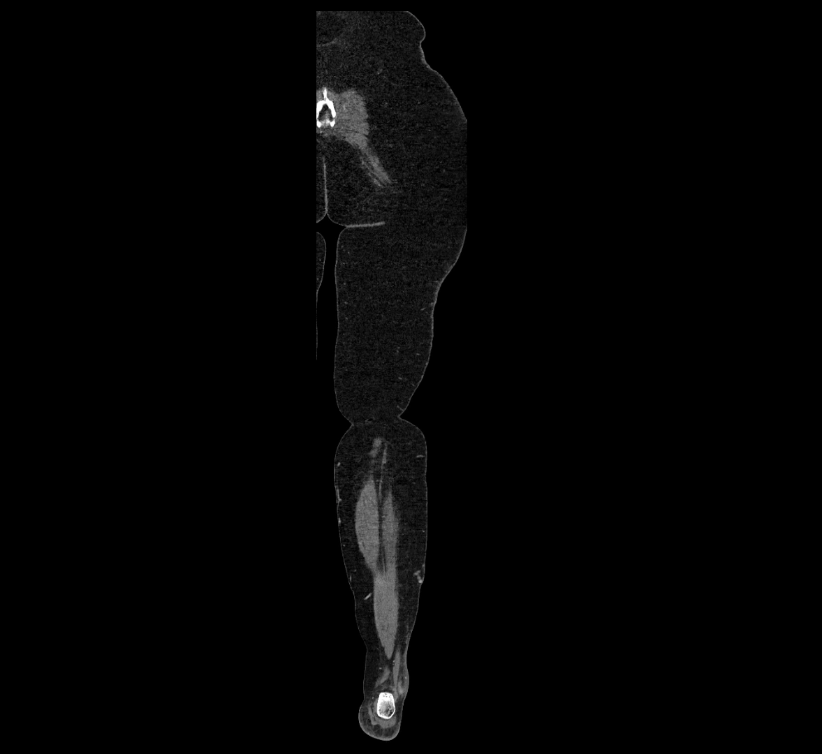 CTA lower limb coronal cross sectional anatomy labelled image _82 (2).webp
